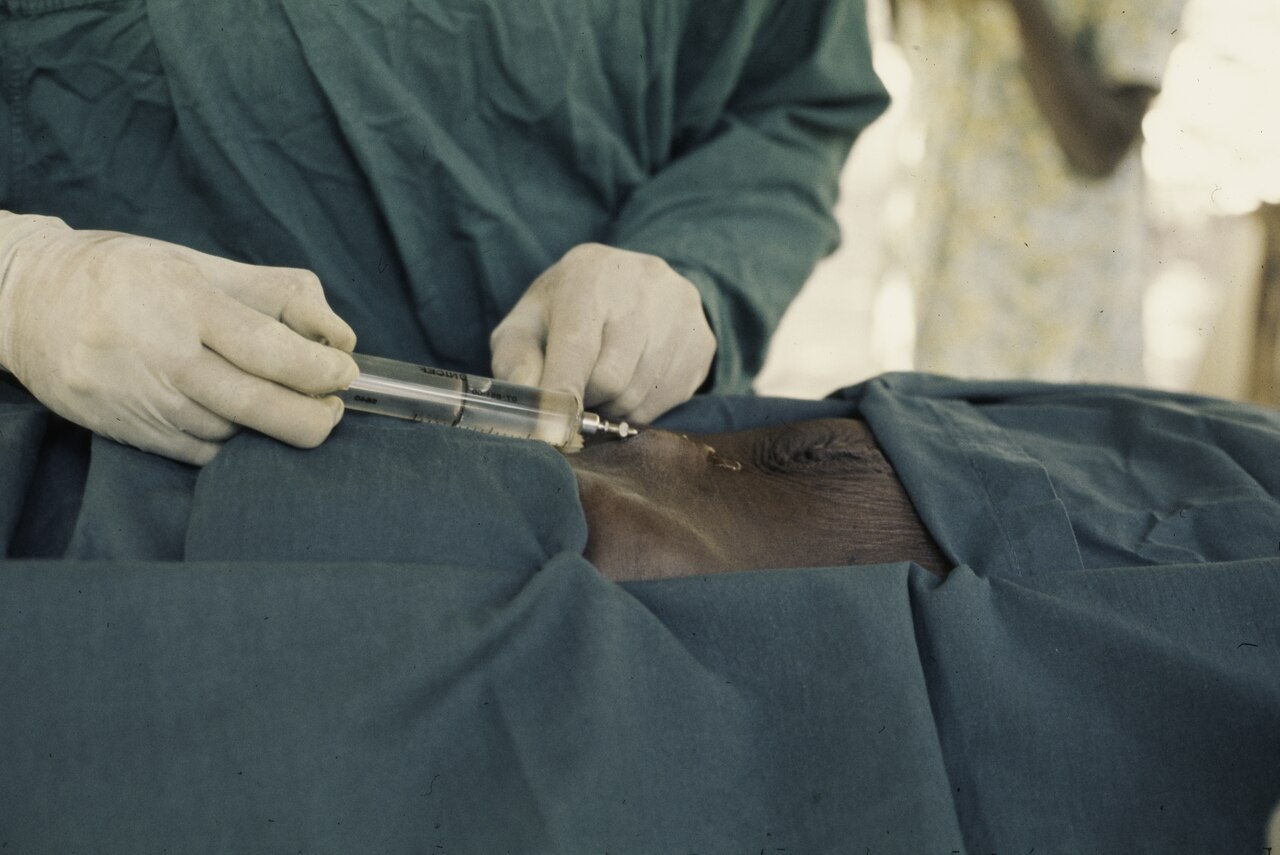 Local anesthesia