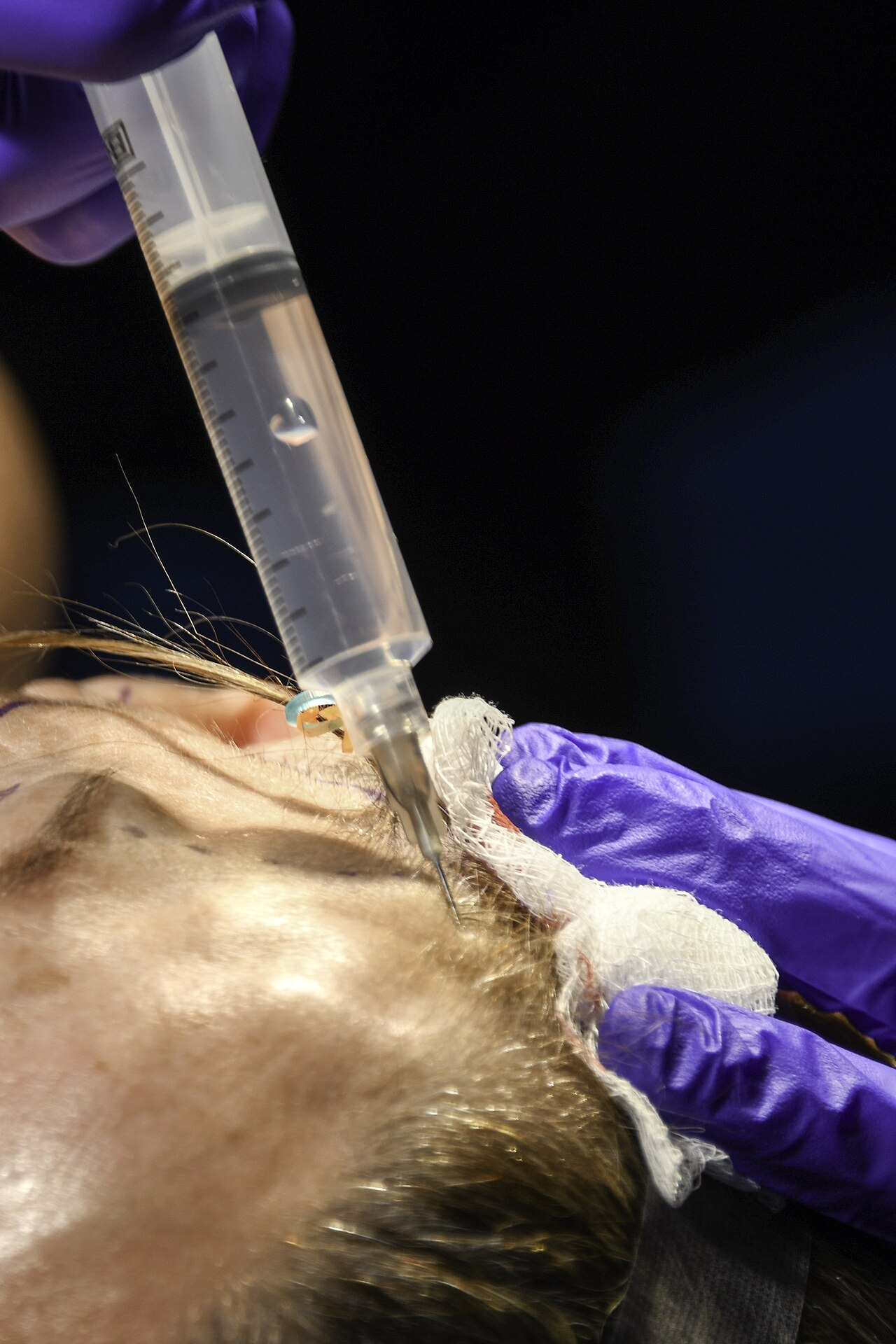 Local anesthesia