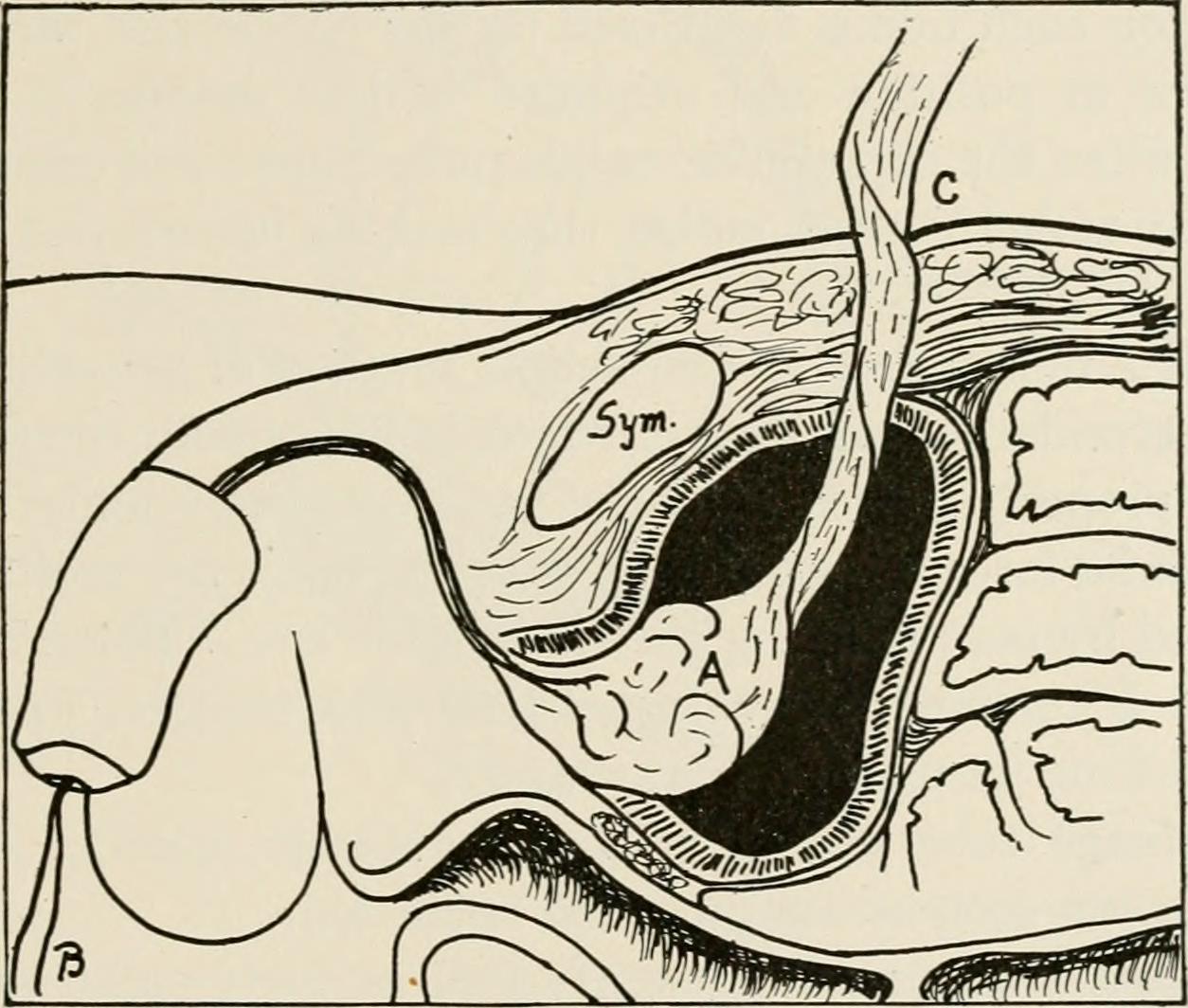 Local anesthesia