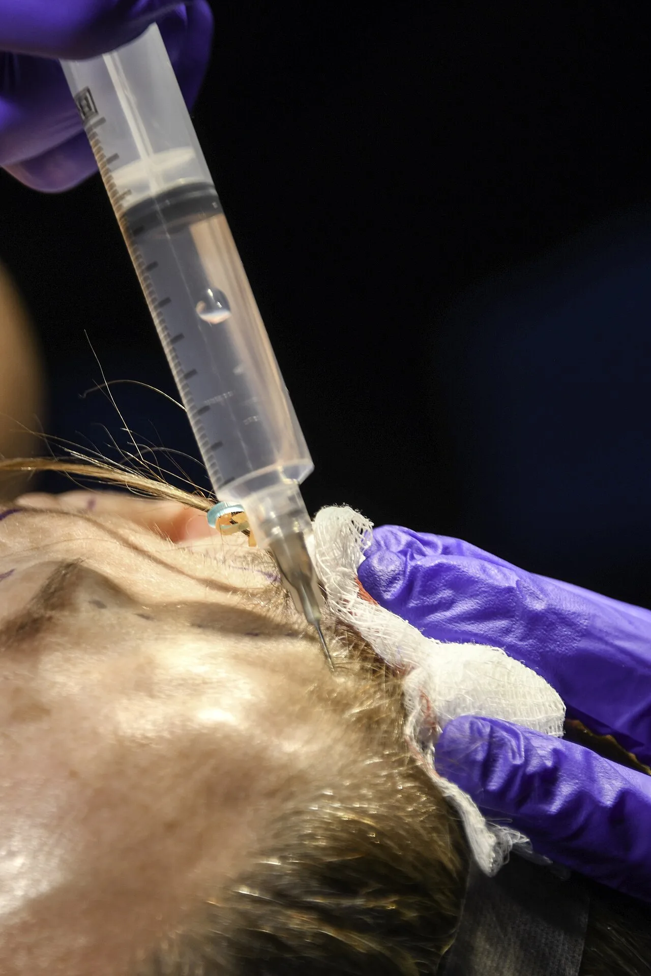 Local anesthesia