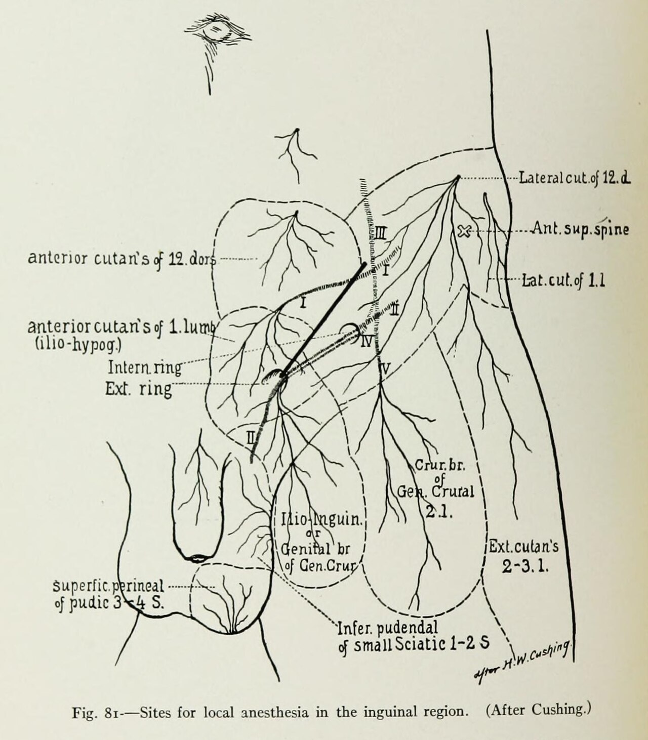 Local anesthetic